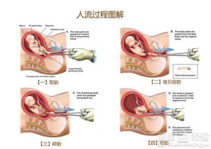 无痛人流半个月后出血，原因、处理与预防措施