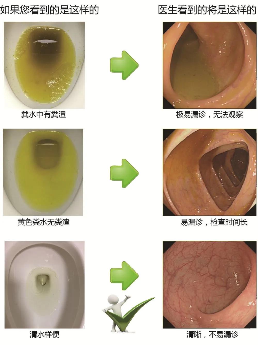 两个月宝宝拉水样大便的原因及应对措施