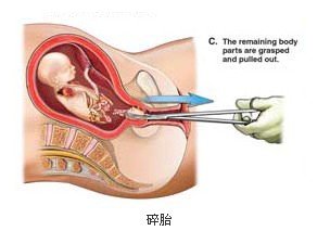 间隔两个月人流，关于人流手术与恢复的重要知识
